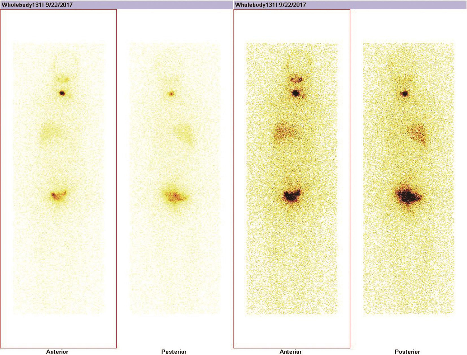 /uploads/image/2025-05-26/164104952图16 131I全身碘扫示颈部甲状腺位置见局部放射性浓聚灶.jpg 图16 131I全身碘扫示颈部甲状腺位置见局部放射性浓聚灶